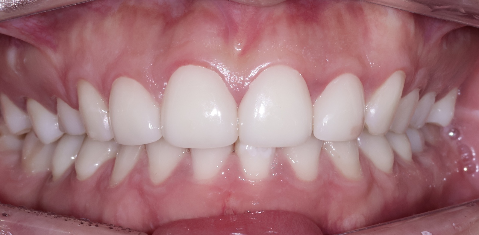 모드치과 위아래 앞니의 맞물림을 보여주는 정면 구강사진, anterior occlusion view